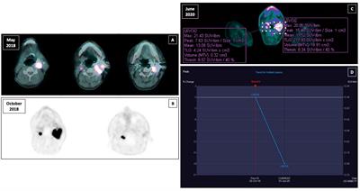 Sunitinib Treatment for Advanced Paraganglioma: Case Report of a Novel SDHD Gene Mutation Variant and Systematic Review of the Literature